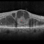 Keeping an eye on the eyes